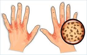 Image result for human scabies