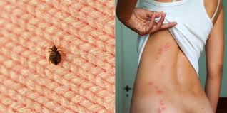 Other times, bites and stings could occur inside the house. Bug Bites Pictures Symptoms Treatment And Prevention