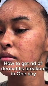 Im going to make more videos about my skin journey! I struggle with eczema  and dermatitis, food definitely plays apart! #dermatitis #dermatitischeck  #eczema #skincaretips #djiboutitiktok #somali ...