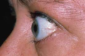 We did not find results for: Exophthalmos Bulging Eyes Nhs