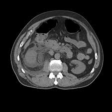 Image result for Nephrolithiasis Imaging
