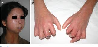 Image result for Systemic Sclerosis