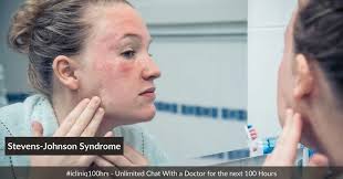 Stevens-Johnson Syndrome