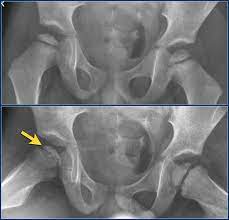 Legg calvé perthes disease is a condition characterized by a temporary loss of blood supply to the top of the femur. The Radiology Assistant Hip Pathology In Children