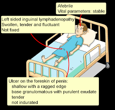 Image result for chancroid