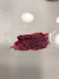 Miscarriage blood clots pictures 2 weeks. At 6 Weeks What Should I Expect During My Miscarriage I Passed This Clot And Blood Will There Be More Glow Community