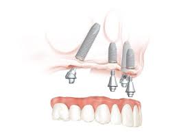 Thousands of people have turned to crowdfunding as a great way to find financial relief for unexpected. Teeth In One Day All On Four Dental Implants In Vancouver Burnaby Bc