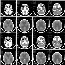 Signs and symptoms treatment resources for families find a doctor clinical. New Target In Childhood Brain Cancer Harvard Medical School