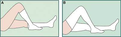 A Knee High Graduated Compression Stockings B Thigh High Graduated Download Scientific Diagram