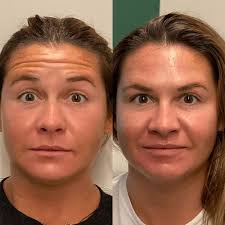 Once you've had botox injected, the effects on the muscles usually become. How Long Does It Take For Botox To Work Boss Gal Beauty Bar