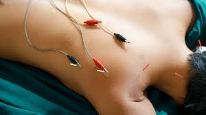 Image result for Acupuncture