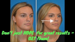 Scar Following Open Rhinoplasty with Dr. Richard Parfitt (Is It Noticeable?)