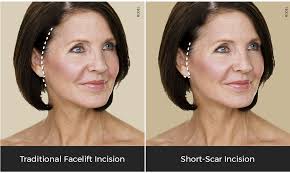 Facelift & Neck Lift for San Jose and Palo Alto, CA