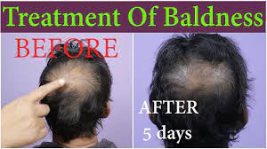 Men and women are suffering from many major hair problems like baldness, hair loss, hair thinning, dandruff and dry hair. Best Hair Regrowth Herbal Oil By Herbhair For Baldness Or Alopecia Youtube