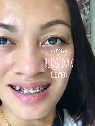 Sebelum pergi kedokter gigi hendaknya redakan dulu rasa nyeri gusi akibat iritasi dengan mengunyah buah cengkeh yang hitam dan tua. Braces Part 1 Kena Tahu Dulu Info Baru Start Dengan Journey Ok Dunia