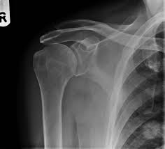 Image result for Fall on Shoulder