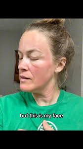 part 2 Post Moxie … showing day one progression. #moxielaser  #moxietreatment #laserseason #scitonlaser #lasertreatment #scitonmoxi  #lasertattooremoval