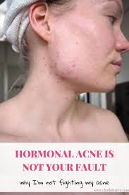 Read my story to see what worked and what changed my life. Hormonal Acne Is Not Your Fault Charlotta Eve Hormonal Acne Acne Hormones