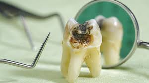 Cara Mencegah Dan Mengatasi Gigi Berlubang Harapan Ibu Hospital Harapan Ibu Hospital