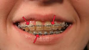 We did not find results for: Invisalign Cosmetic Dentist Nyc
