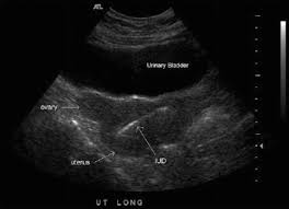 Subsequently, question is, how do i know if my insurance covers my iud? Intrauterine Device Removal Springerlink