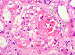 In multiple sclerosis, the protective coating on nerve fibers (myelin) is damaged and may eventually be destroyed. Gefys