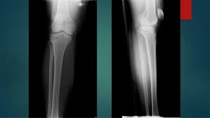 Injury then directed upward and laterally tearing interosseous membrane and anterior inferior tibiofibular ligament. Maisonneuve Fracture