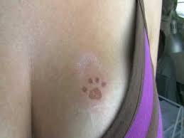 Allergic Reaction To Black Henna Tattoo Before Treatment Youtube