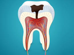 The cost of wisdom tooth extraction depends on. Painless Wisdom Teeth Extraction South Delhi India