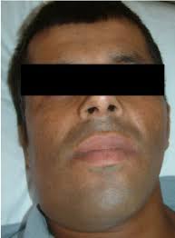 Well-nourished patient with swelling of the submental and right...