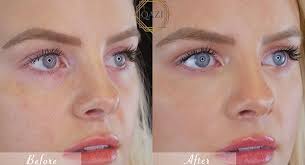 Has My Lip Filler Migrated? Are My Lips Normal? - L1P Aesthetics
