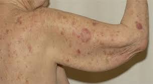 Check spelling or type a new query. Mehr Als Nur Der Schmetterling Ein Leitfaden Durch Die Vielfalt Des Kutanen Lupus Erythematodes Springerlink