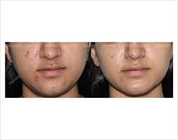 If you have botox or dermal fillers in the area to be treated, wait 14 days both before and after injection to receive treatments. Laser Hair Removal Before After Result Hairmd Pune
