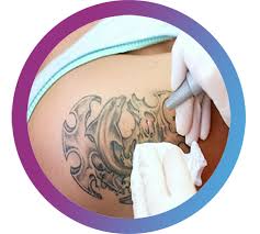 Medically proven safe and effective. Laser Tattoo Removal Laser Tattoo Removal Treatment Sakhiya Skin Clinic Pvt Ltd Surat Id 16700246862