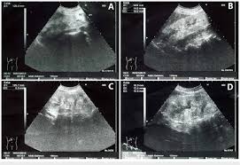 Increased Renal Cortical Echogenicity Does Not Always Indicate Chronic  Kidney Disease – Nephropocus