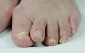 Ambillah 8 helai daun keembung putih dan tumbuk sampai halus. Elak Jangkitan Kulat Kuku