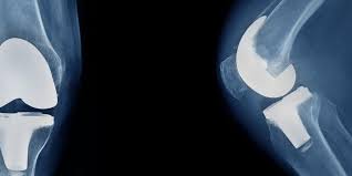 Work on achieving full knee extension at this. Loose Bodies In The Knee Rothman Orthopaedic Institute