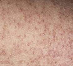 We did not find results for: Keratosis Pilaris Walk In Dermatology
