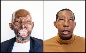 Syphilitic chancre of the lips transmitted by kissing: Meet The First African American Face Transplant Recipient Time