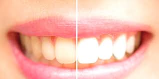 Pin On Natural Teeth Whitening