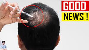 Learn about hair loss prevention, treatment options for alopecia follow all of sciencedaily's latest research news and top science headlines! Cure For Baldness By 2020 Rch 01 Anti Hair Loss Treatment Alopecia Youtube