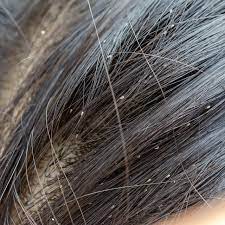 Parasit yang merugikan hewan dan manusia ini dapat berkembang biak dengan cepat apabila dibiarkan. Cara Menghilangkan Telur Kutu Rambut Secara Alami Dan Permanen Citizen6 Liputan6 Com