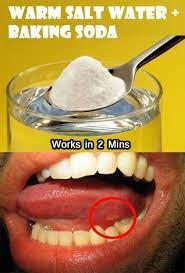 Canker Sore Remedy Using Baking Soda M Got A Canker Sore And We Did This Before Bed Helped A Ton It Was Almost Gone Canker Sore Remedy Canker Sore Remedies
