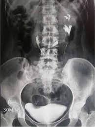 Scielo Brasil Bilateral Duplex Collecting System In Horse Shoe Kidney An Unusual Association Bilateral Duplex Collecting System In Horse Shoe Kidney An Unusual Association