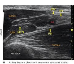 Image result for Axillary Nerve Block