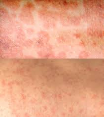 Image result for measles