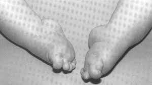 If someone has a club foot , they are born with a badly twisted foot. Clubfoot Congenital Equinovarus Cev Team Bone