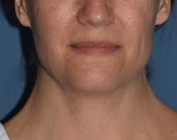 Image result for Webbed Neck