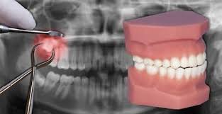 To remove this tooth, the oral surgeon will need. Tooth Extraction Procedure And Guidelines