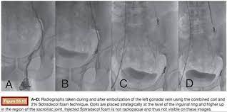 Variables to assess efficacy of treatment were. Varicocele Clinical Applications Embolization Therapy Principles And Clinical Applications 1 Ed